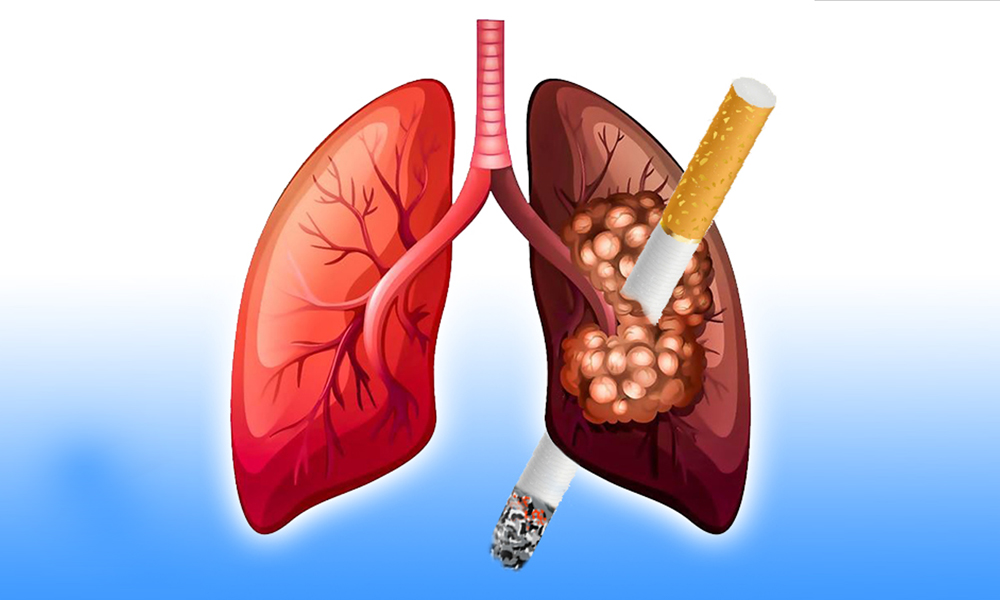 Cai thuốc lá - loại bỏ tác nhân gây ung thư